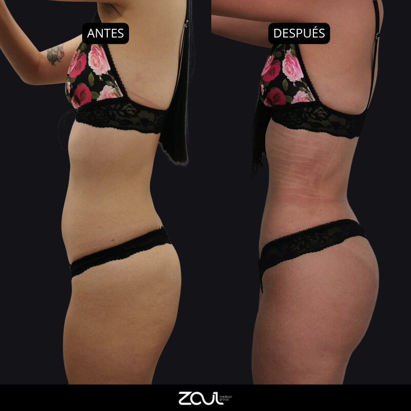 Lipoescultura y lipotransferencia - Dra Carolina Hoyos