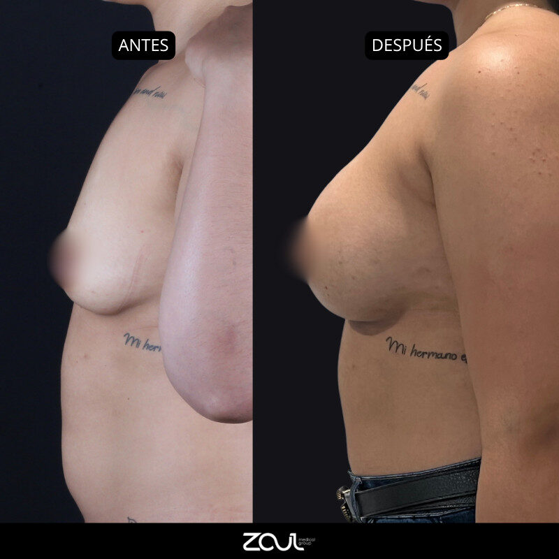 Mamoplastia de aumento con implantes redondos - Dra Carolina Hoyos
