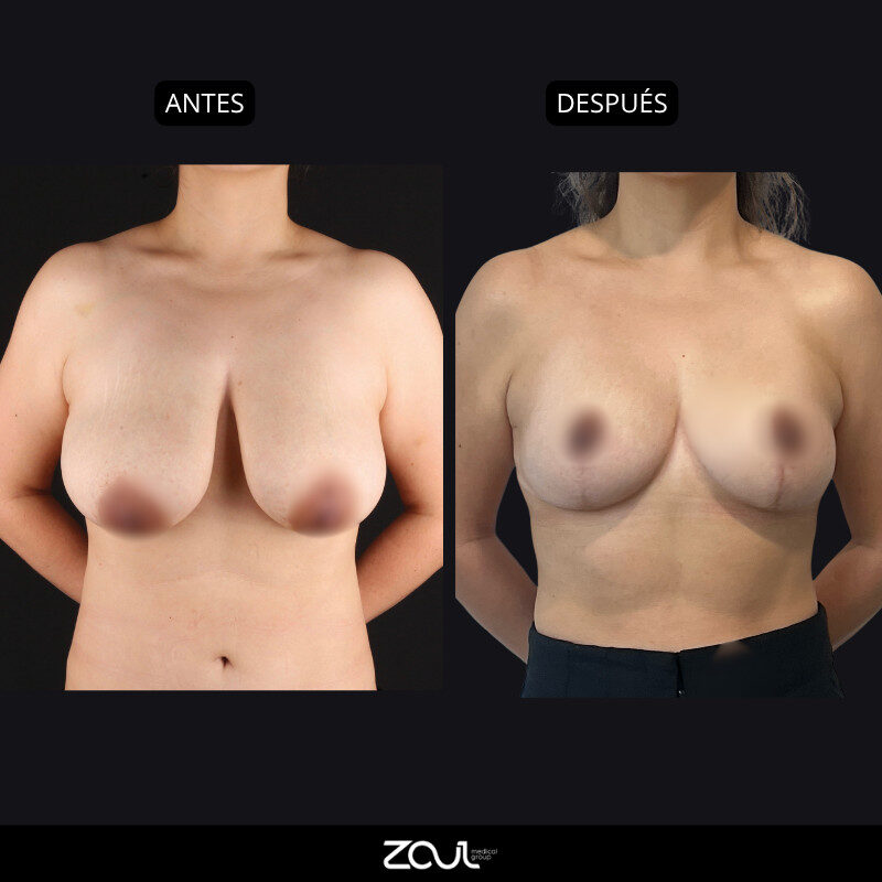 Mamoplastia de reducción - Dra Carolina Hoyos