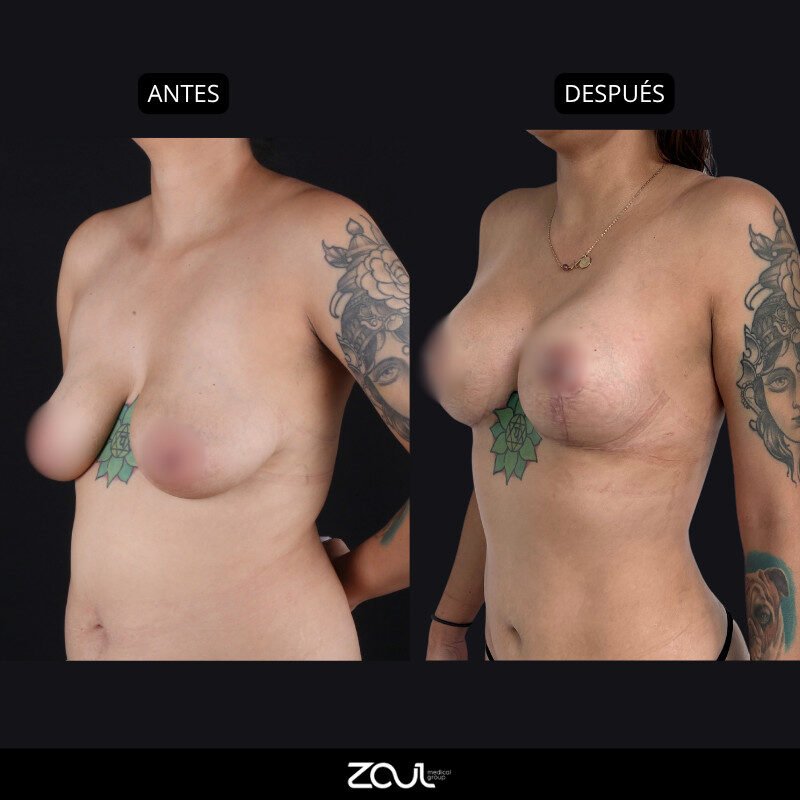 Mastopexia (lifting mamario o levantamiento) - Dra Carolina Hoyos