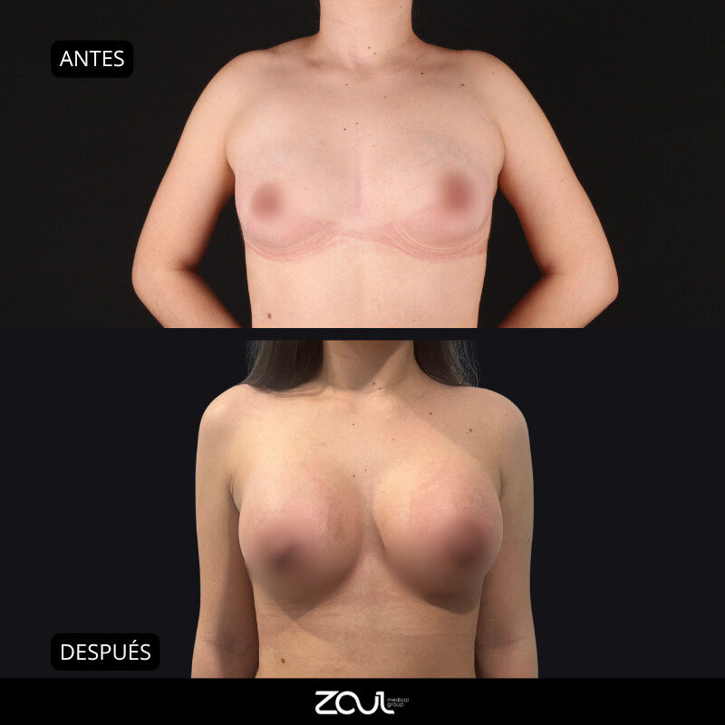Mamoplastia de aumento con implantes redondos - Dra Carolina Hoyos