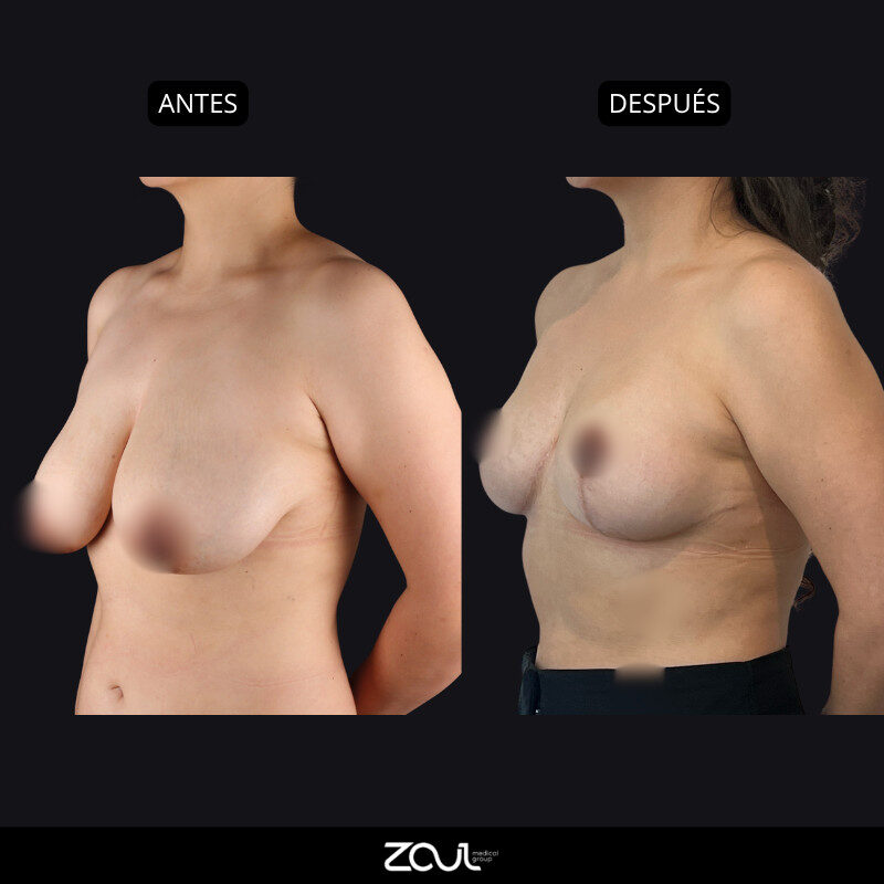 Mamoplastia de reducción - Dra Carolina Hoyos
