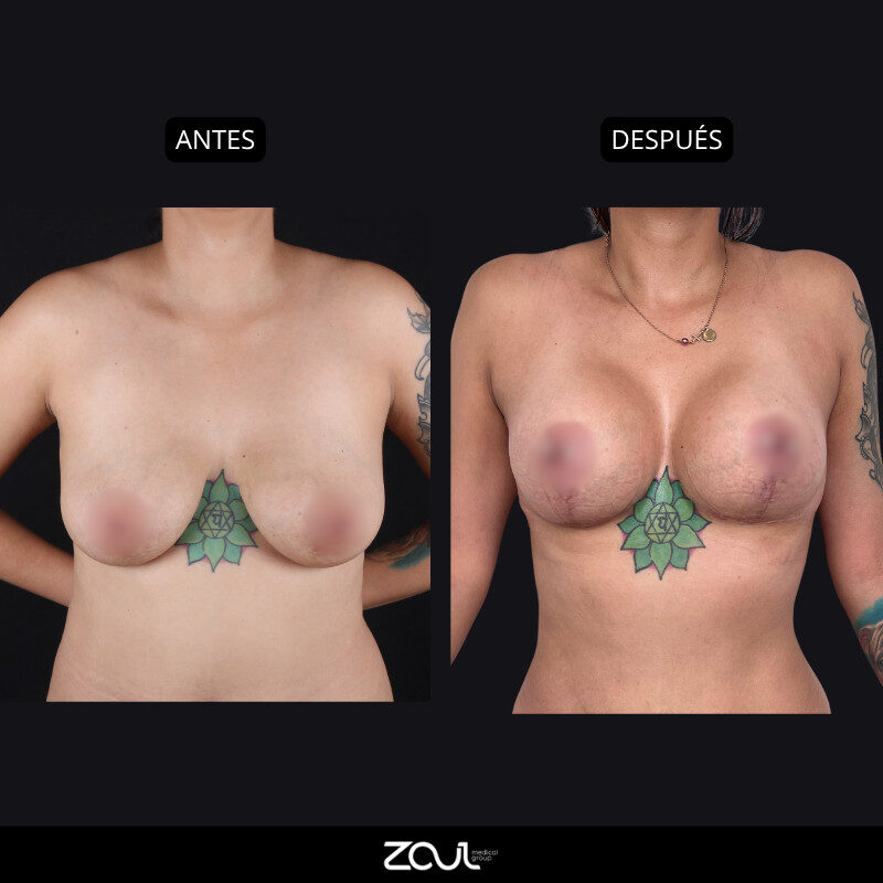 Mastopexia (lifting mamario o levantamiento) - Dra Carolina Hoyos