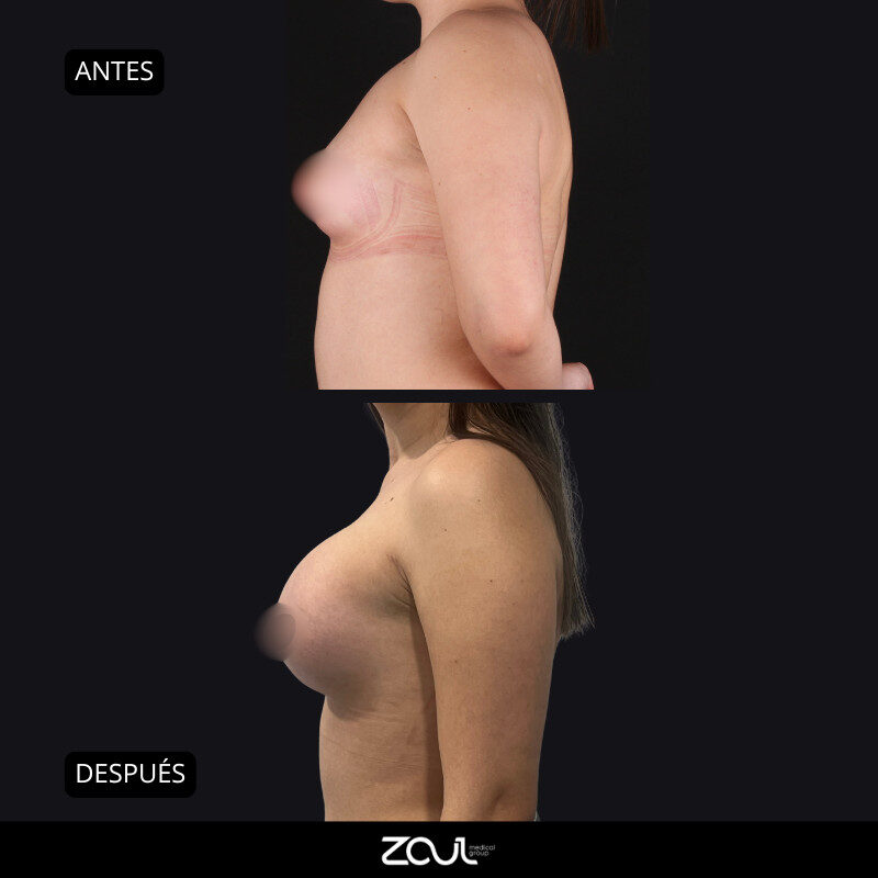 Mamoplastia de aumento con implantes redondos - Dra Carolina Hoyos