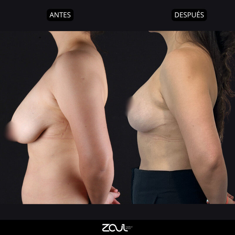 Mamoplastia de reducción - Dra Carolina Hoyos