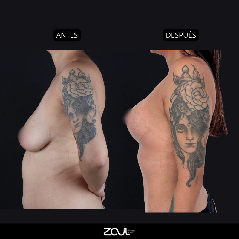 Mastopexia (lifting mamario o levantamiento) - Dra Carolina Hoyos