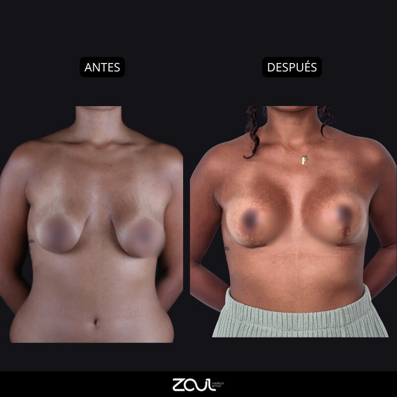 Mastopexia (lifting mamario o levantamiento) - Dra Carolina Hoyos