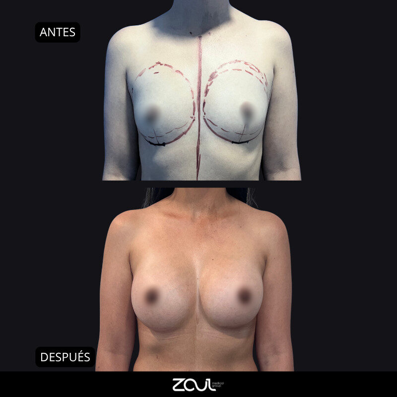 Mamoplastia de aumento con implantes redondos - Dra Carolina Hoyos