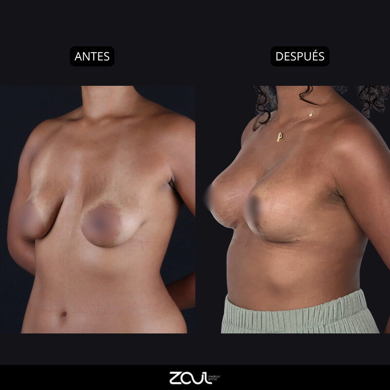 Mastopexia (lifting mamario o levantamiento) - Dra Carolina Hoyos
