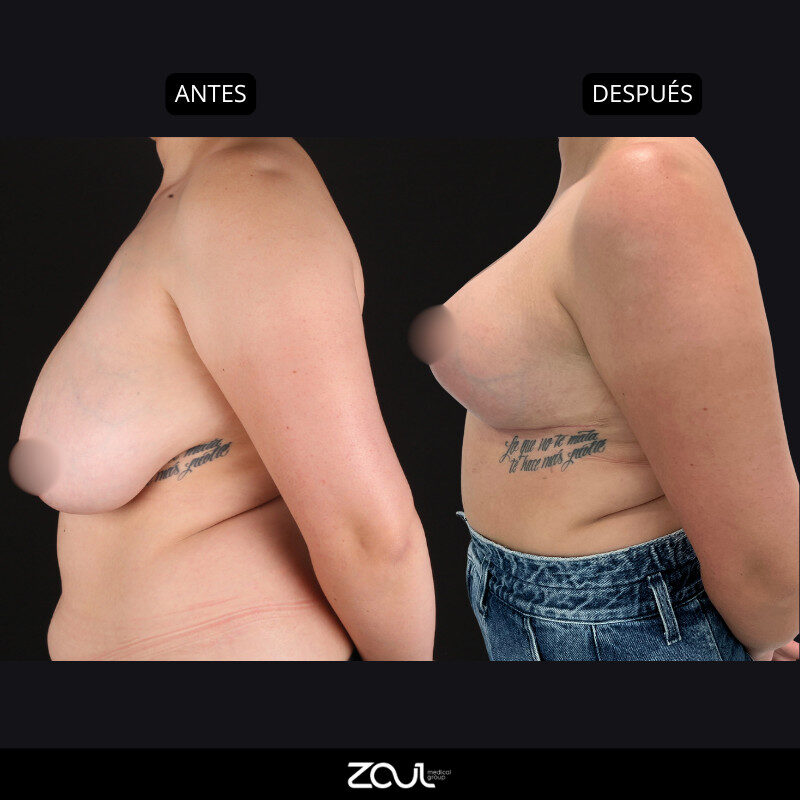 Mamoplastia de reducción - Dra Carolina Hoyos
