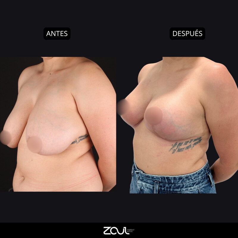 Mamoplastia de reducción - Dra Carolina Hoyos