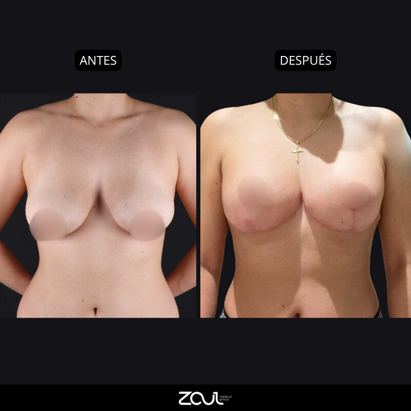 Mastopexia (lifting mamario o levantamiento) - Dra Carolina Hoyos