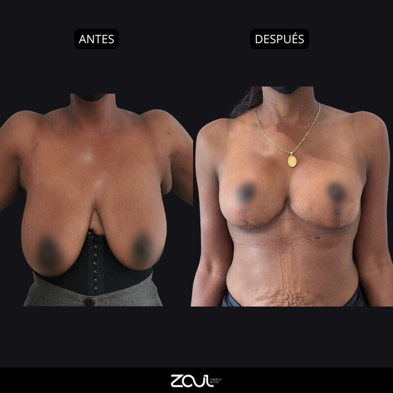 Mamoplastia de reducción - Dra Carolina Hoyos