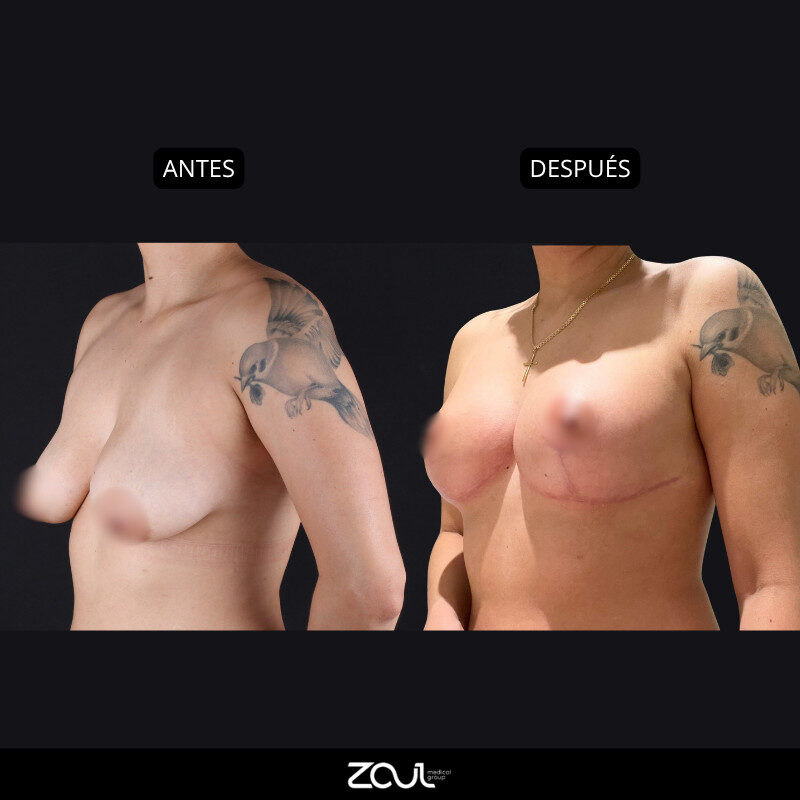 Mastopexia (lifting mamario o levantamiento) - Dra Carolina Hoyos