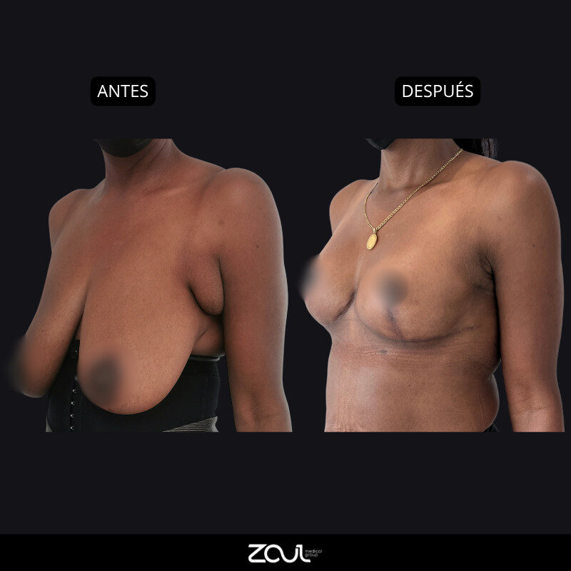 Mamoplastia de reducción - Dra Carolina Hoyos