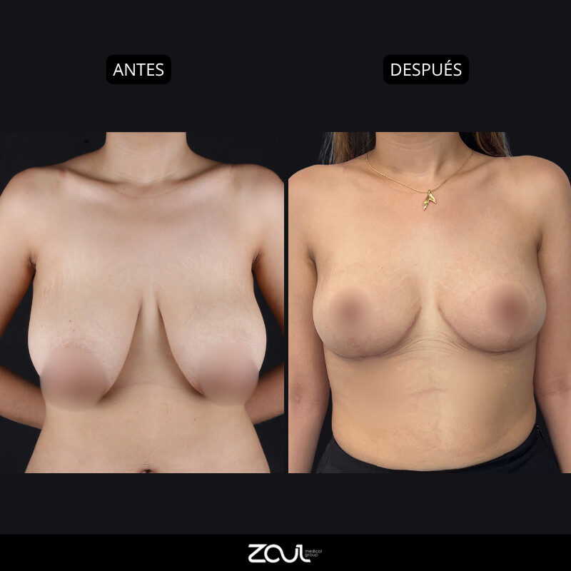 Mamoplastia de reducción - Dra Carolina Hoyos