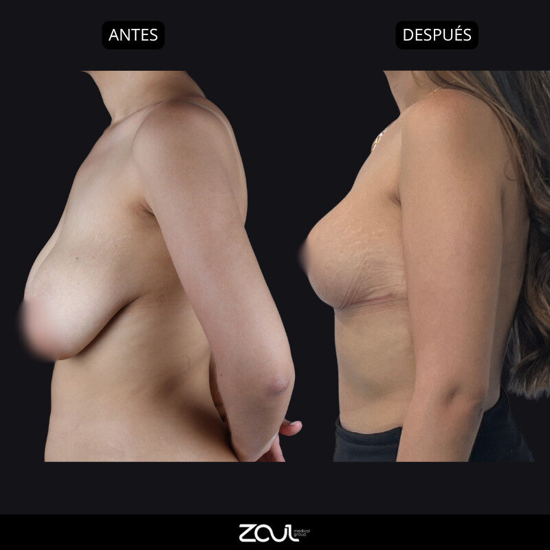 Mamoplastia de reducción - Dra Carolina Hoyos