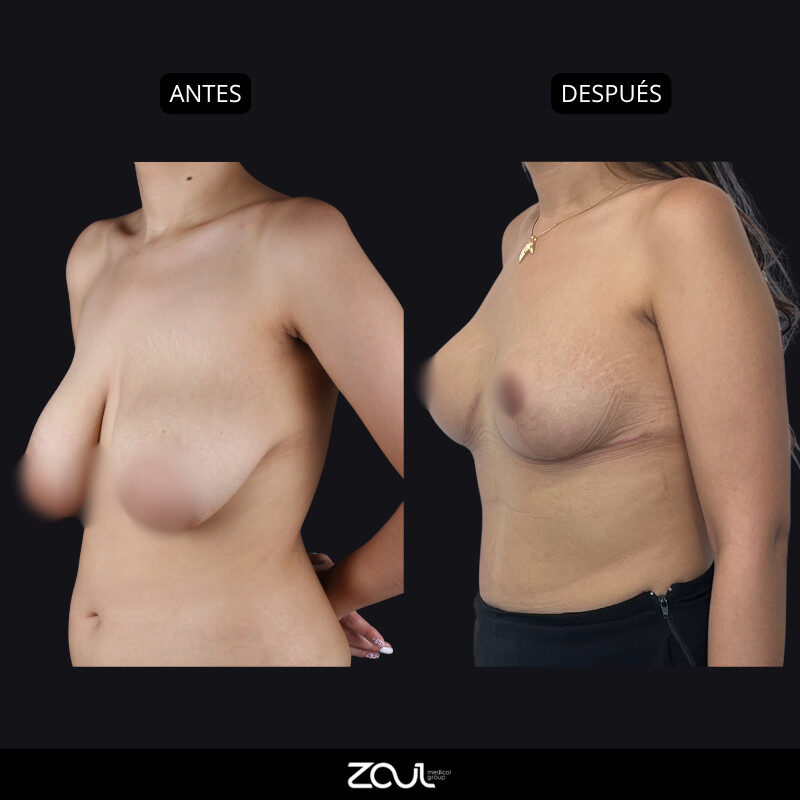 Mamoplastia de reducción - Dra Carolina Hoyos