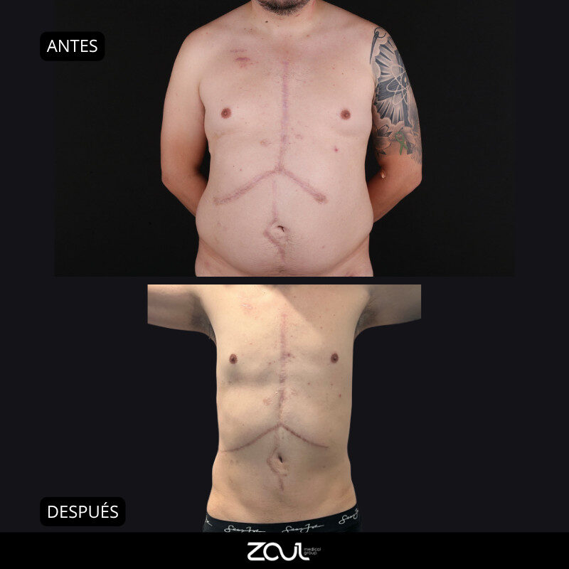 Abdominoplastia (reconstrucción de pared abdominal) - Dra Carolina Hoyos