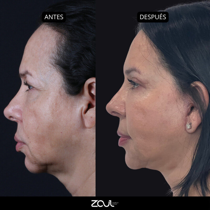 Rejuvenecimiento facial (lifting cara y cuello) - Dra Carolina Hoyos