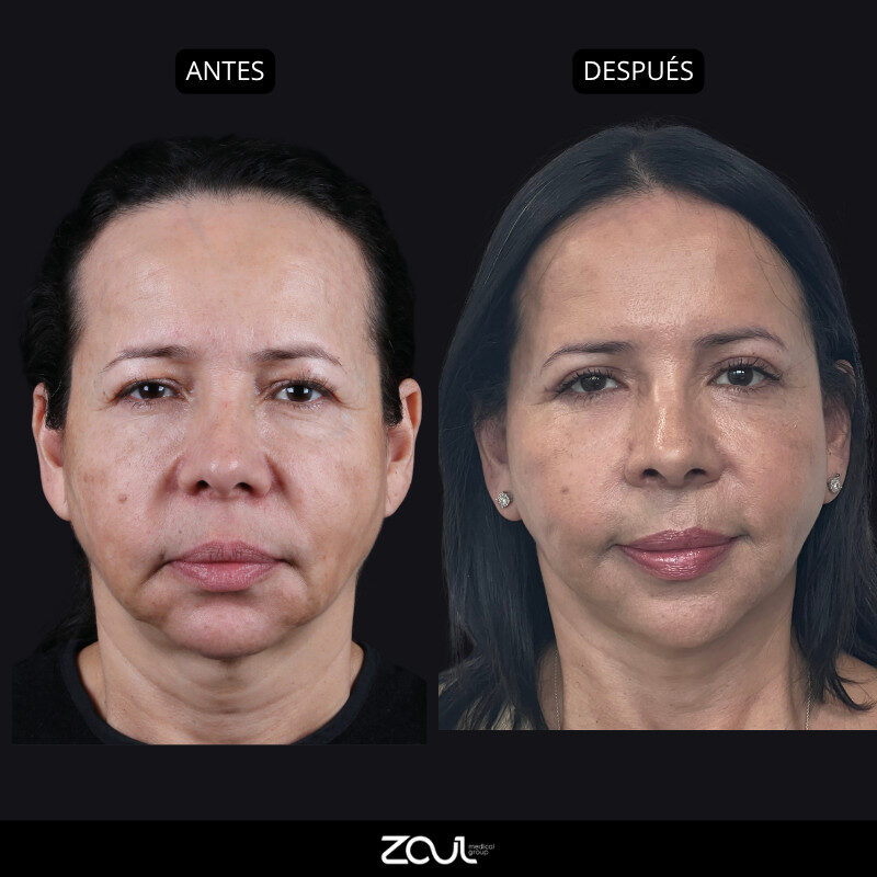 Rejuvenecimiento facial (lifting cara y cuello) - Dra Carolina Hoyos