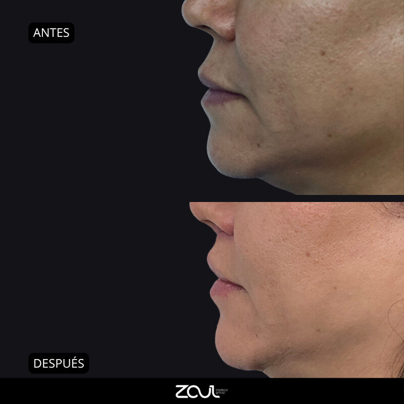 Lifting de labios