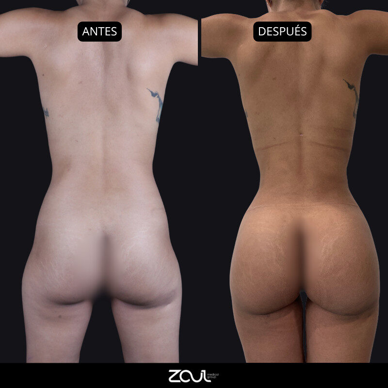 Lipoescultura y lipotransferencia - Dra Carolina Hoyos